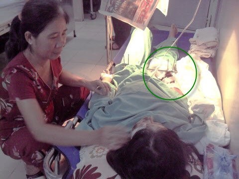 Bà Cúc, mẹ Ngân đang chăm sóc con gái tại bệnh viện. Bàn tay phải của Ngân (trong vòng tròn) đang bất động.